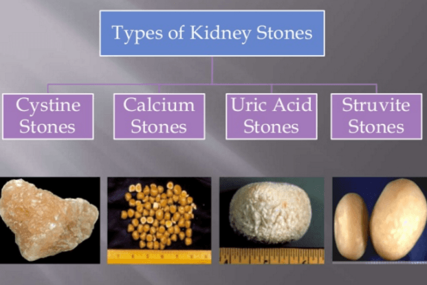 kidney_stones_types